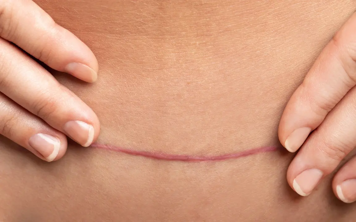 Two hands frame a thin pink scar on the skin.